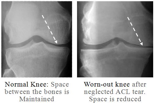 acl-reconstruction-surgery