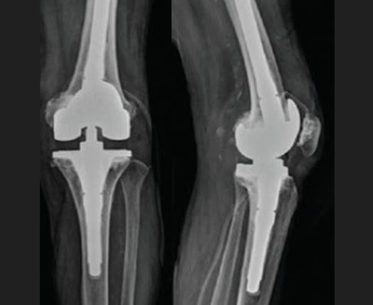 failed-knee-surgery