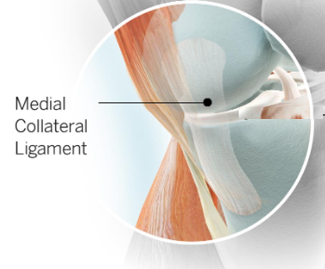 ligament-mcl-tear